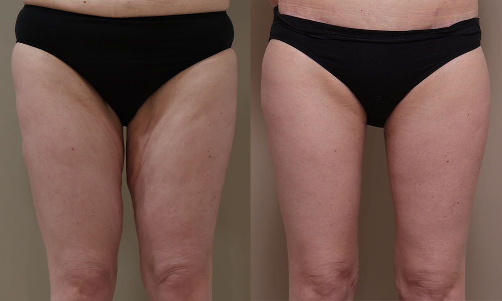 Thigh Lift img 1 1 Gallery Thigh Lift - 4