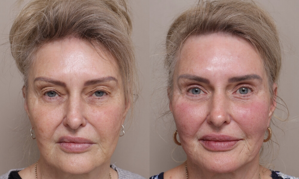 Bilateral Upper Blepharoplasty patient 4 1 Gallery Blepharoplasty - 5