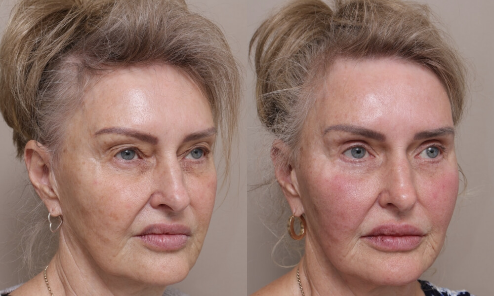 Bilateral Upper Blepharoplasty patient 4 2 Gallery Blepharoplasty - 6