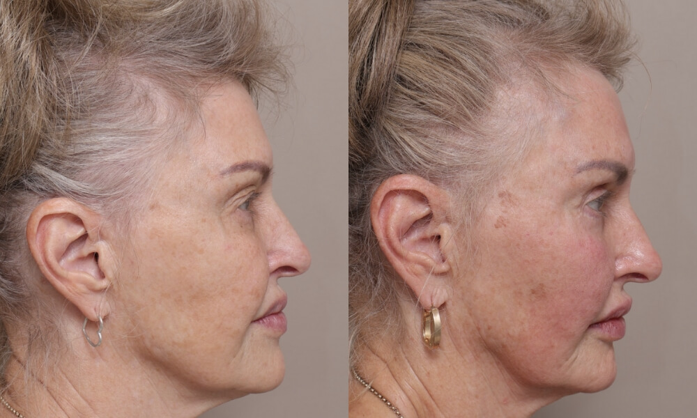 Bilateral Upper Blepharoplasty patient 4 3 Gallery Blepharoplasty - 7