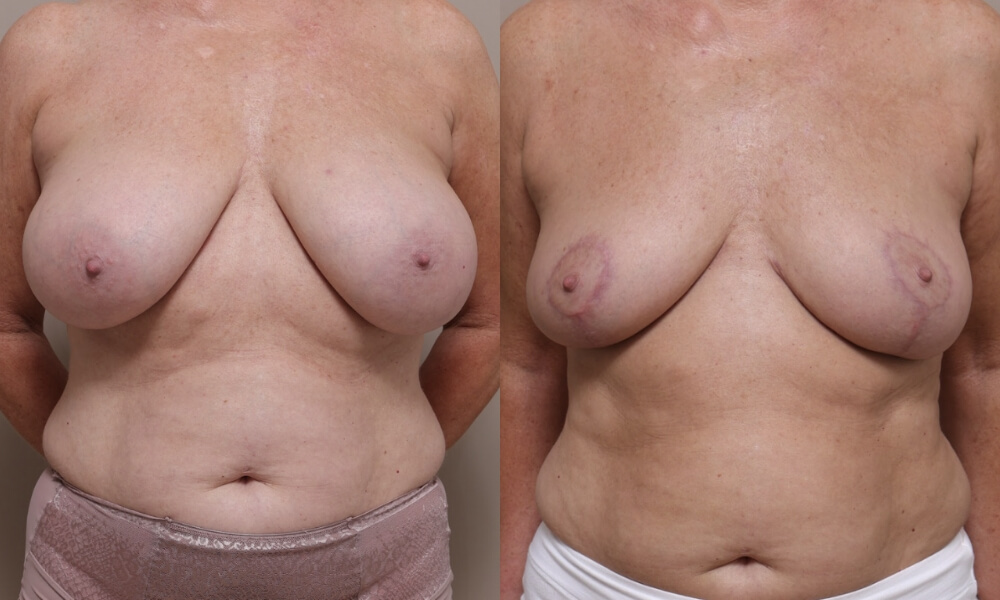 Breast Reduction Patient 2 1 Gallery Breast Reduction - 7