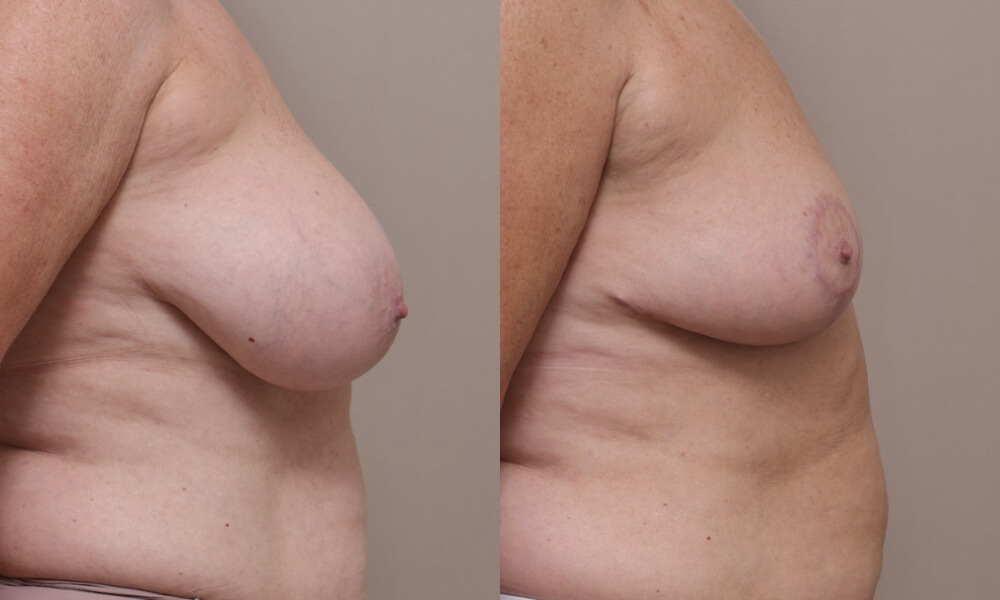 Breast Reduction Patient 2 2 Gallery Breast Reduction - 8