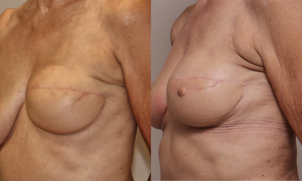 Nipple Reconstruction Patient 1 Gallery Nipple Correction - 8