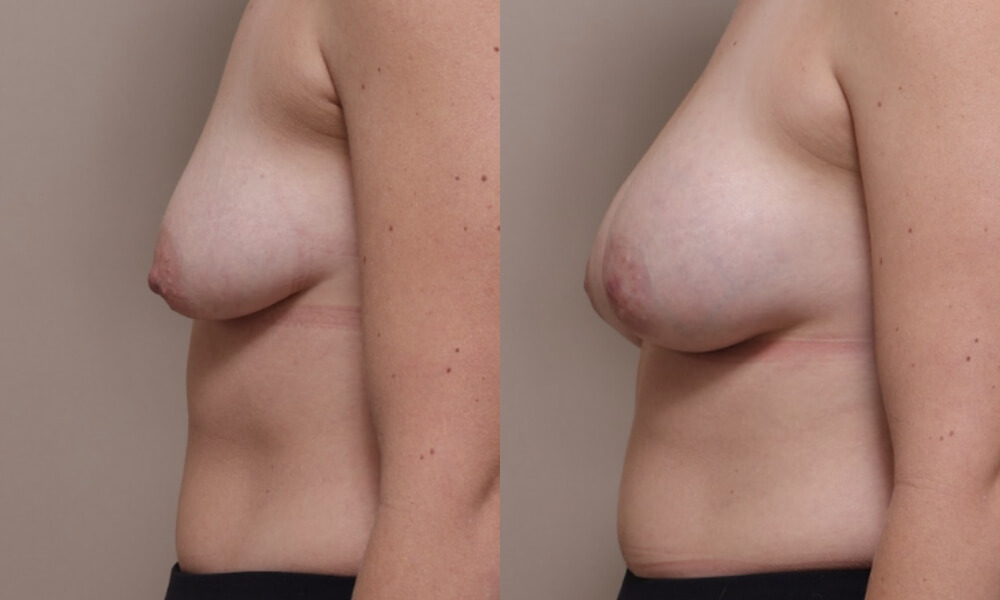 Tuberous Breast Correction 1 2 Gallery Tuberous Breast - 2