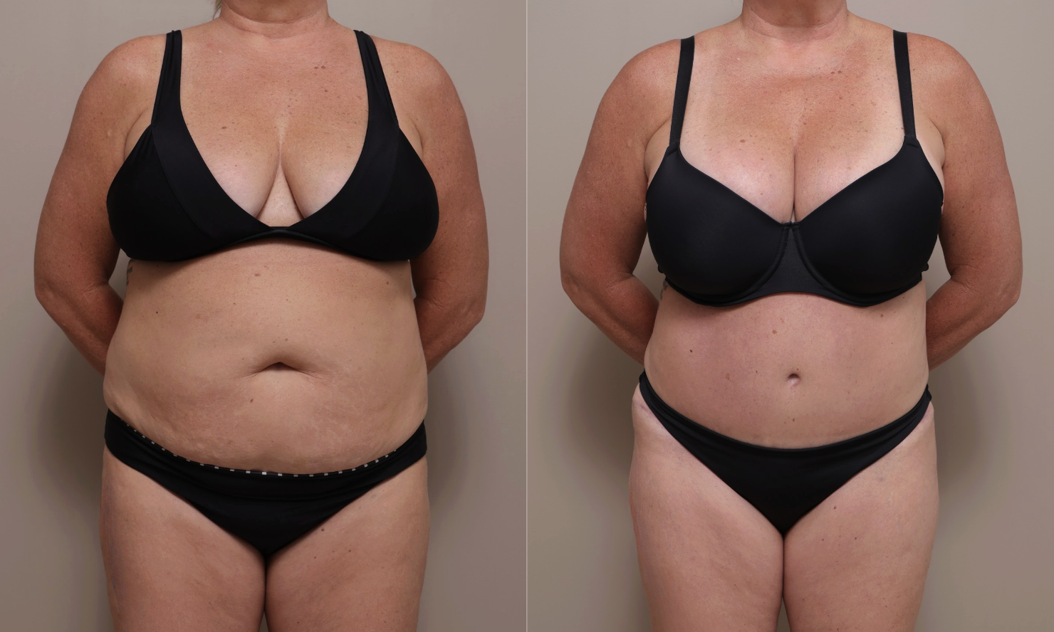 Screenshot 2026 04 23 at 12.27.43 PM Gallery Abdominoplasty - 7