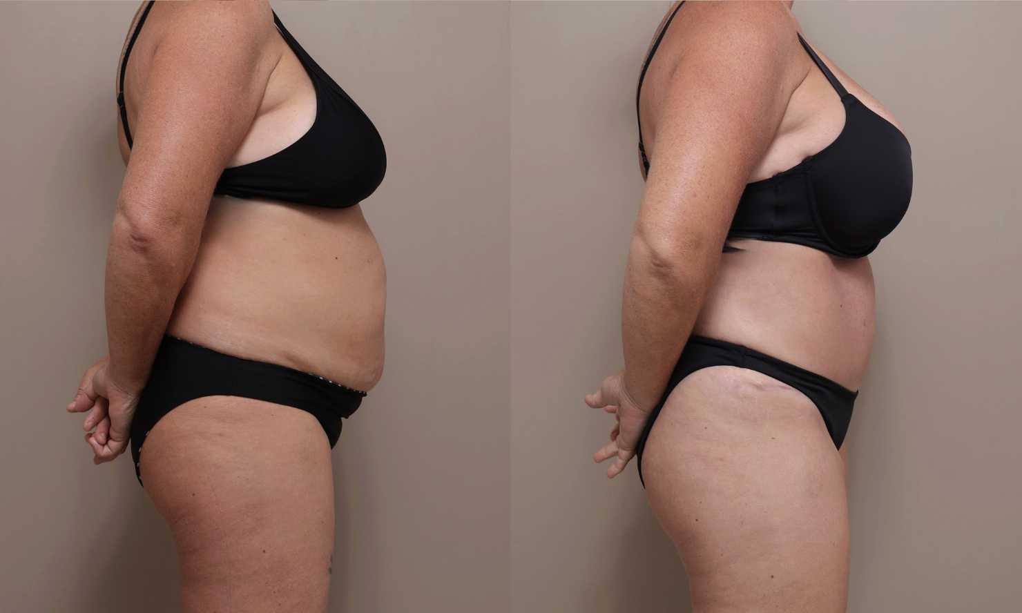 Screenshot 2026 04 23 at 12.43.11 PM Gallery Abdominoplasty - 9