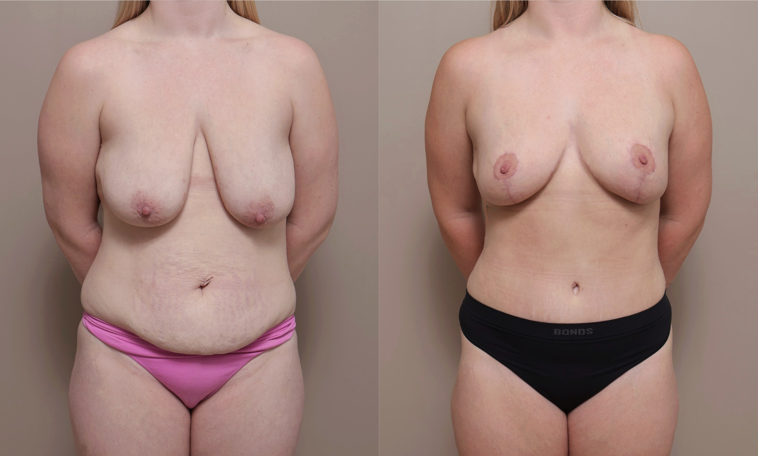 Screenshot 2026 04 23 at 12.50.30 PM Gallery Breast Reduction - 1