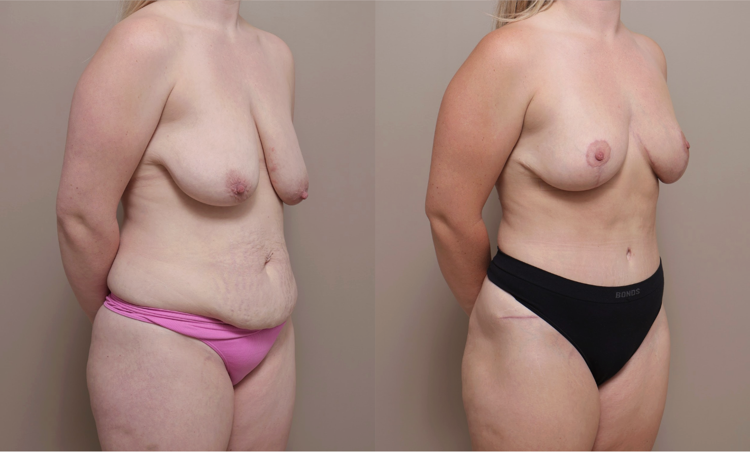 Screenshot 2026 04 23 at 12.56.26 PM Gallery Breast Reduction - 2
