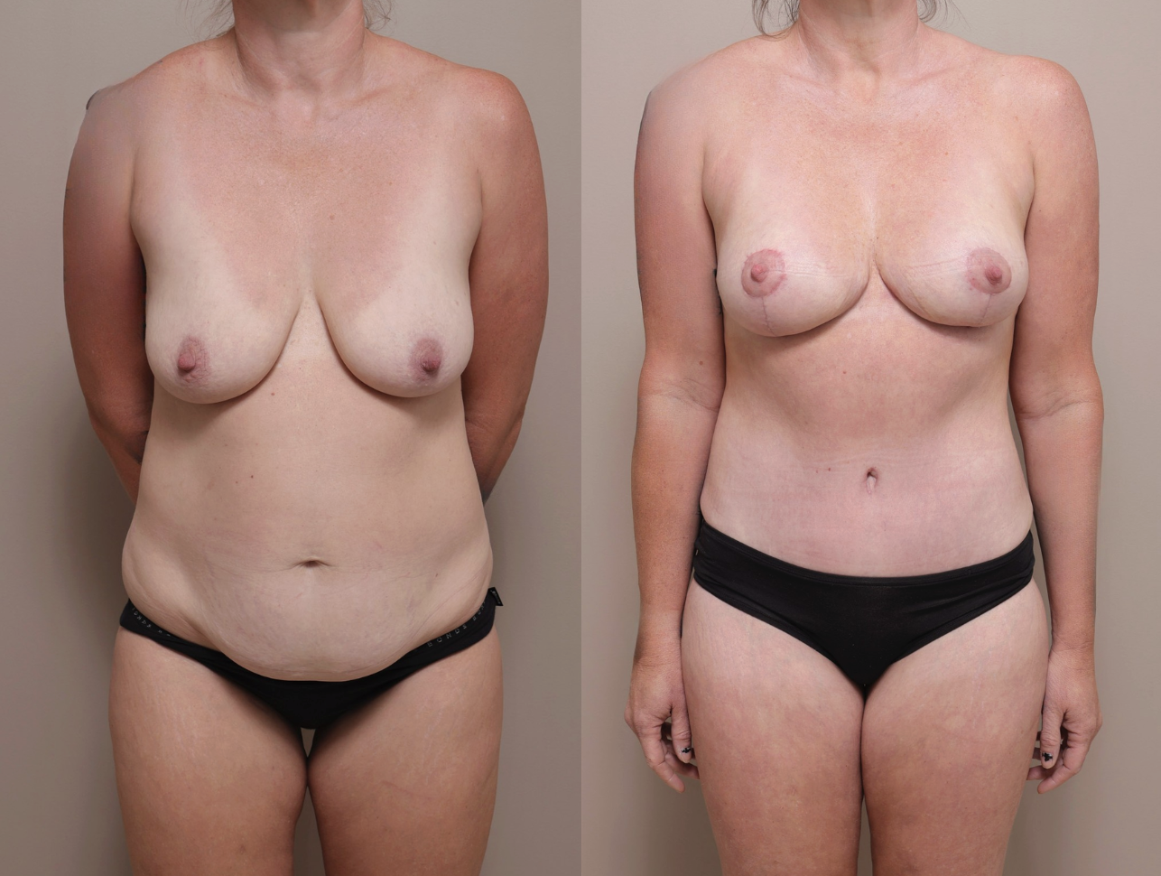 Screenshot 2026 04 28 at 10.48.30 AM Gallery Abdominoplasty - 1