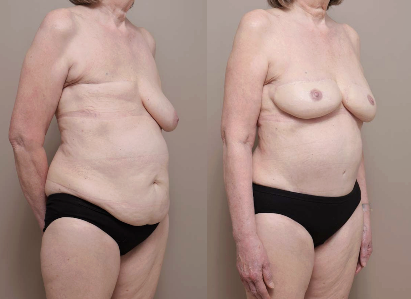 Screenshot 2026 04 28 at 11.50.01 AM Gallery Nipple Correction - 5