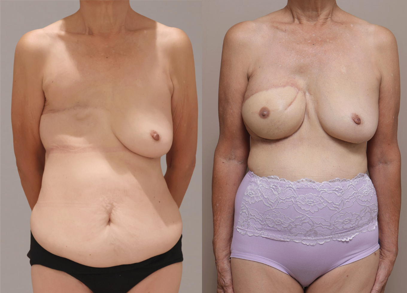 Screenshot 2026 04 28 at 12.07.41 PM Gallery Nipple Correction - 1