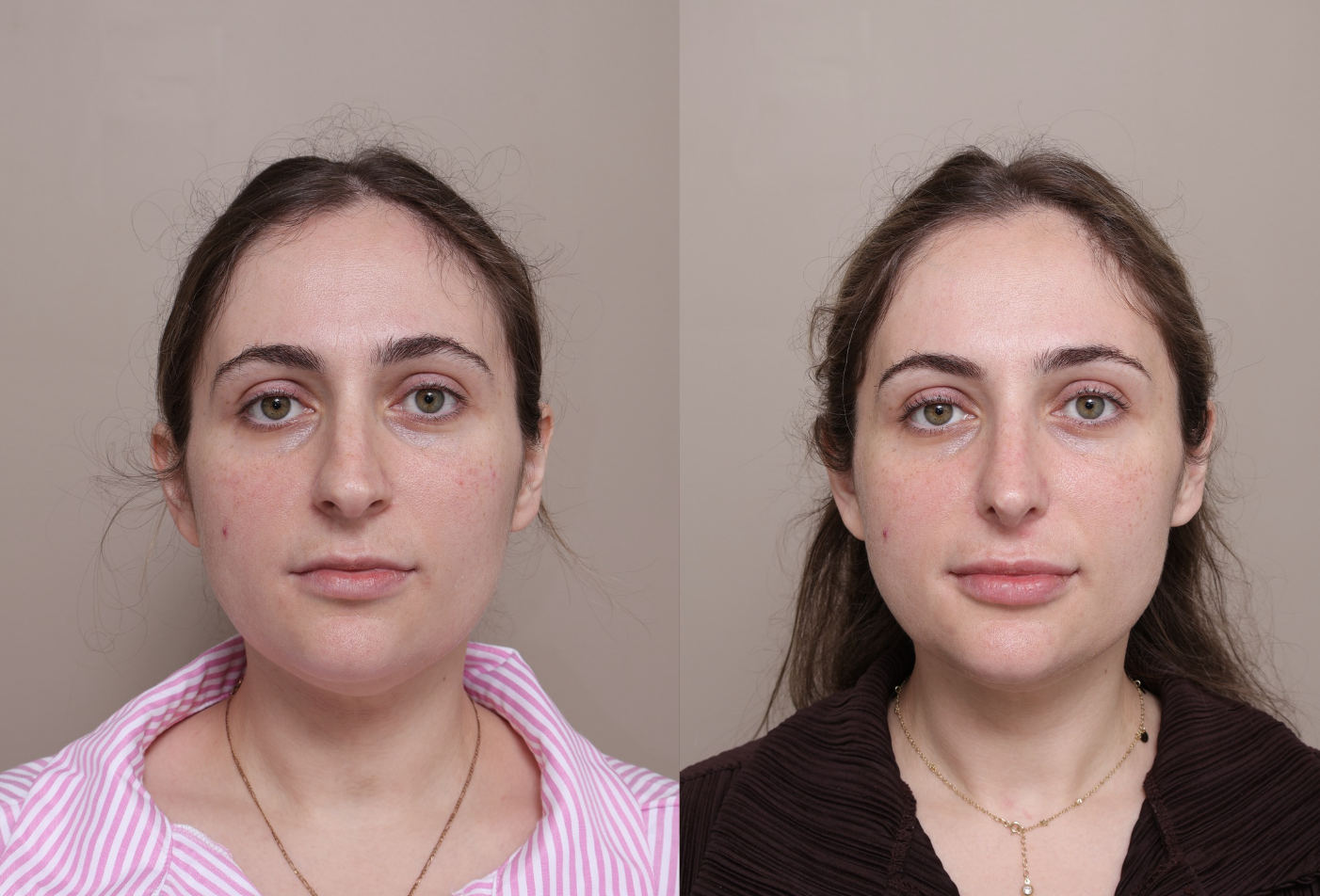 Screenshot 2026 04 30 at 1.39.57 pm Gallery Rhinoplasty - 1