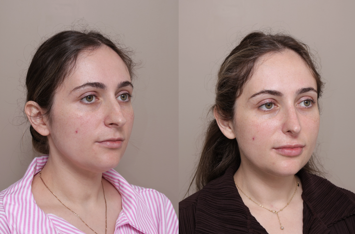 Screenshot 2026 04 30 at 1.41.01 pm Gallery Rhinoplasty - 2