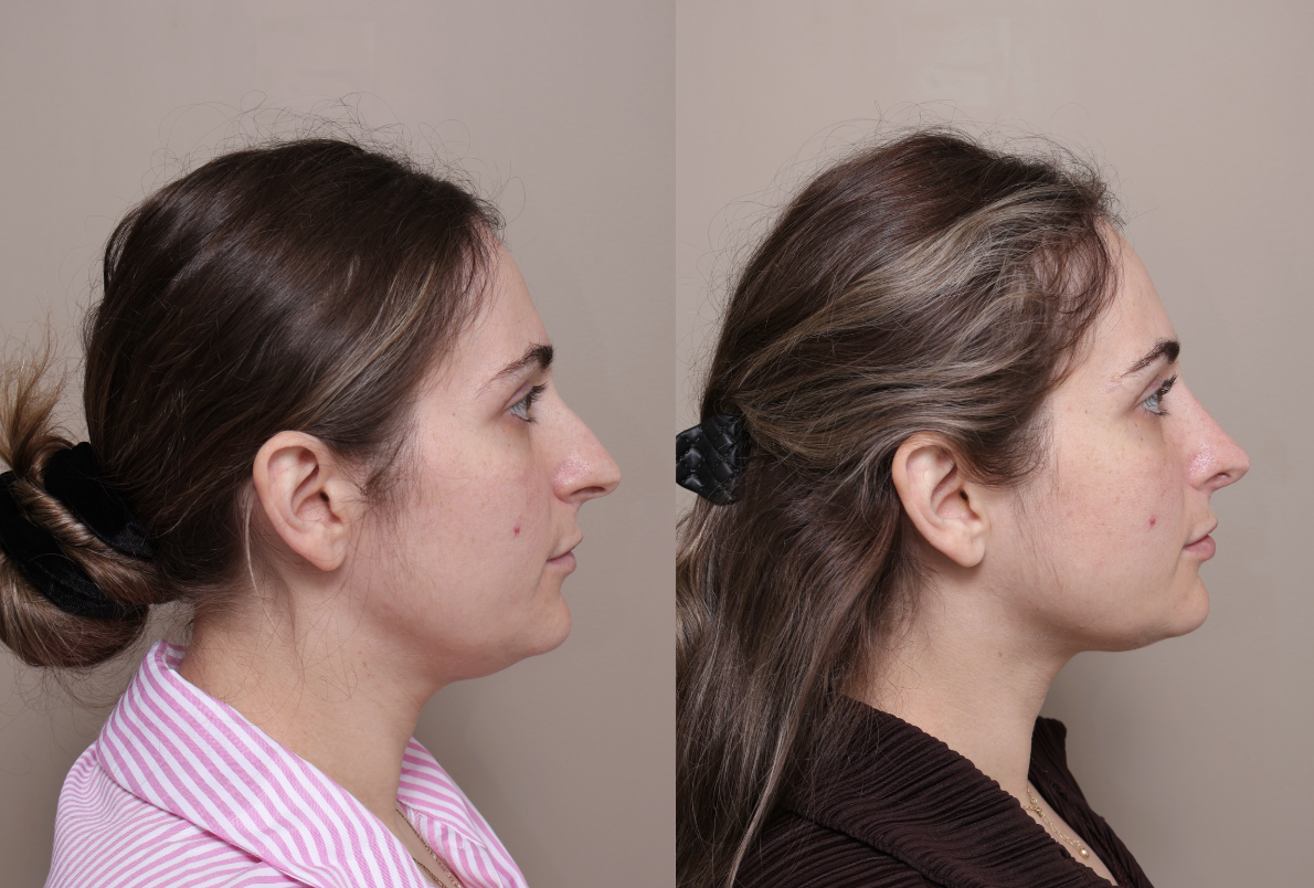 Screenshot 2026 04 30 at 1.42.08 pm Gallery Rhinoplasty - 3