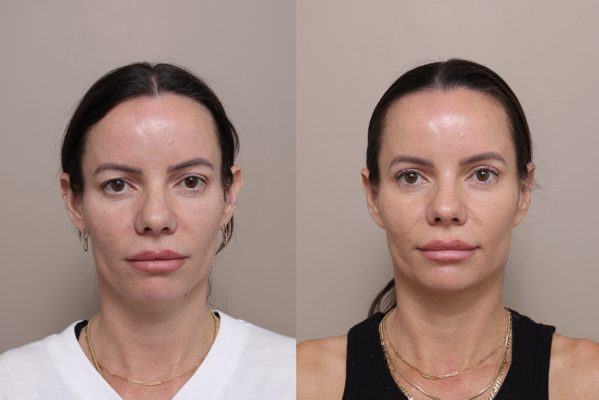 Screenshot 2026 04 30 at 1.44.33 pm Gallery Blepharoplasty - 1