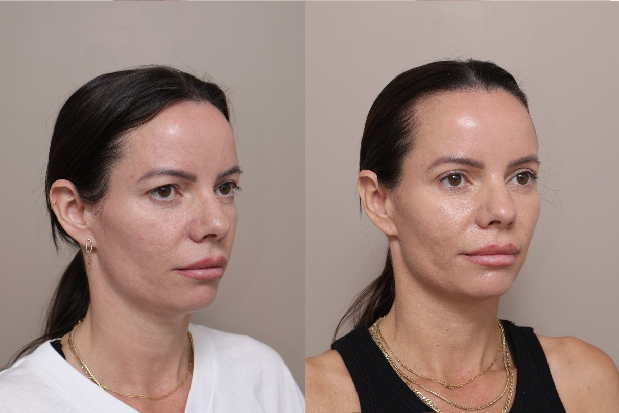 Screenshot 2026 04 30 at 1.45.41 pm Gallery Blepharoplasty - 2
