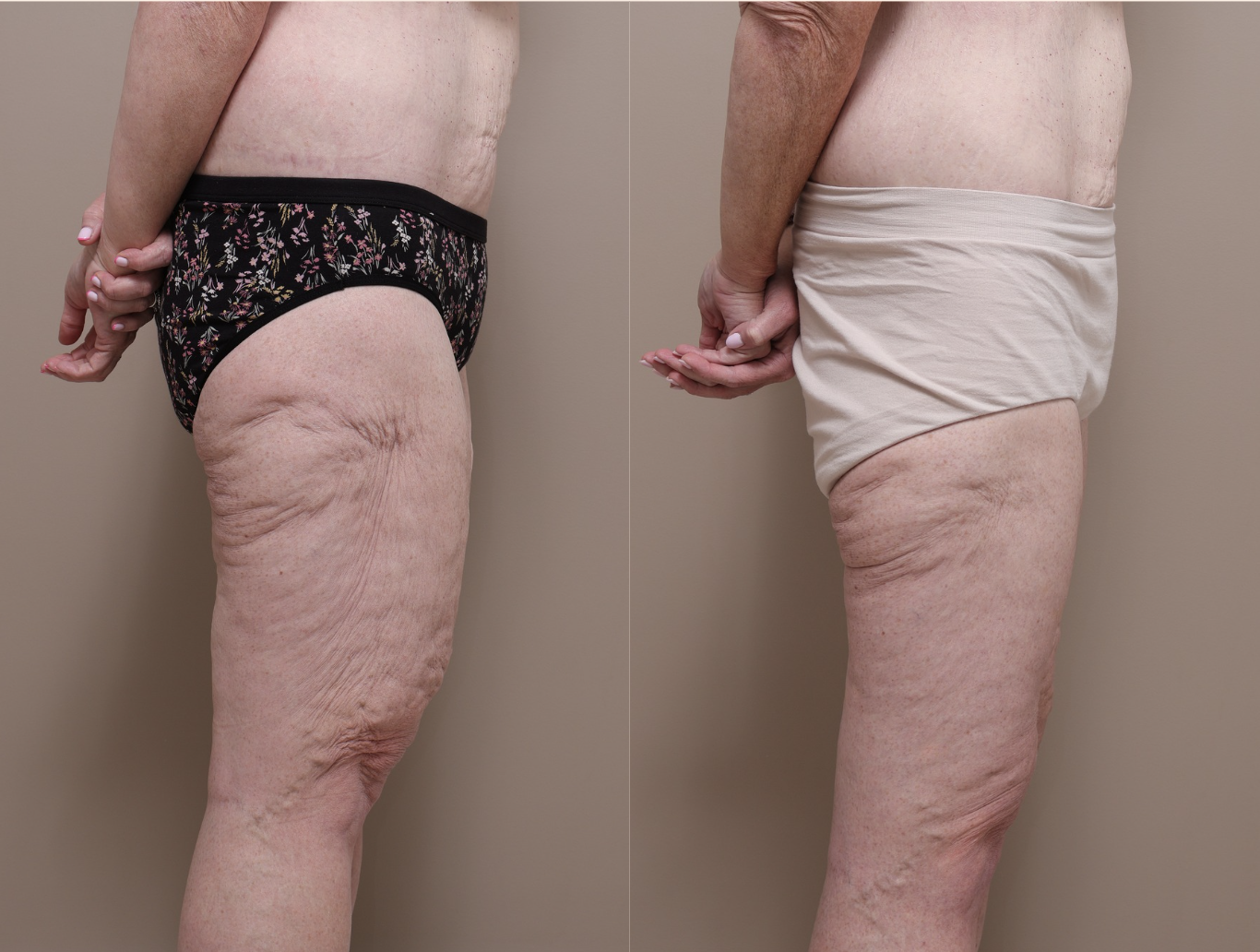 Screenshot 2026 04 30 at 2.00.43 pm Gallery Thigh Lift - 3